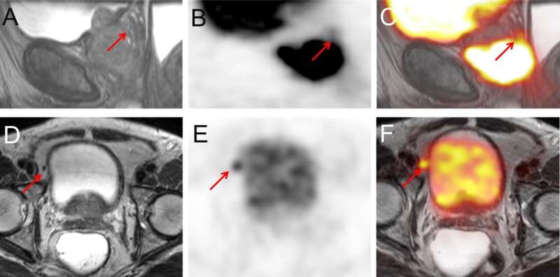 Whole-body PET/MRI provides one-stop shop for staging high-risk prostate cancer patients