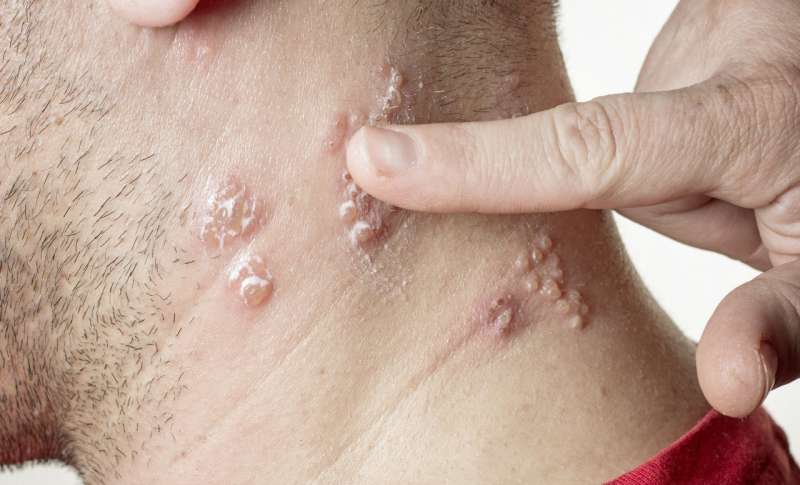 Why getting the new shingles vaccine is a good idea—even if you got the old one