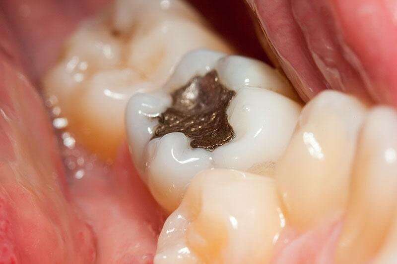 disgusting teeth