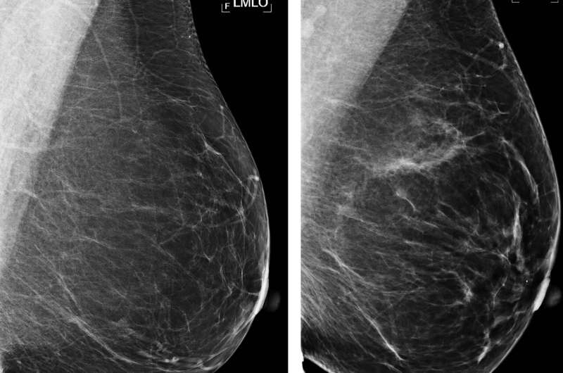 AI improves breast cancer risk prediction