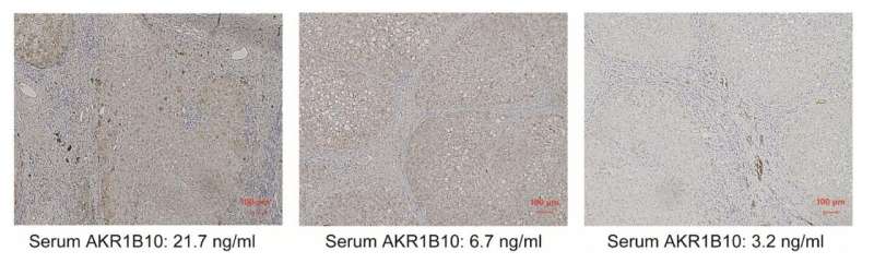 Aldo-keto reductase family 1 member B10 predicts advanced nonalcoholic steatohepatitis