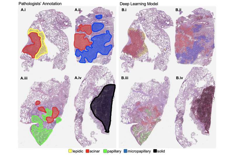A new machine learning model can classify lung cancer slides at the pathologist level