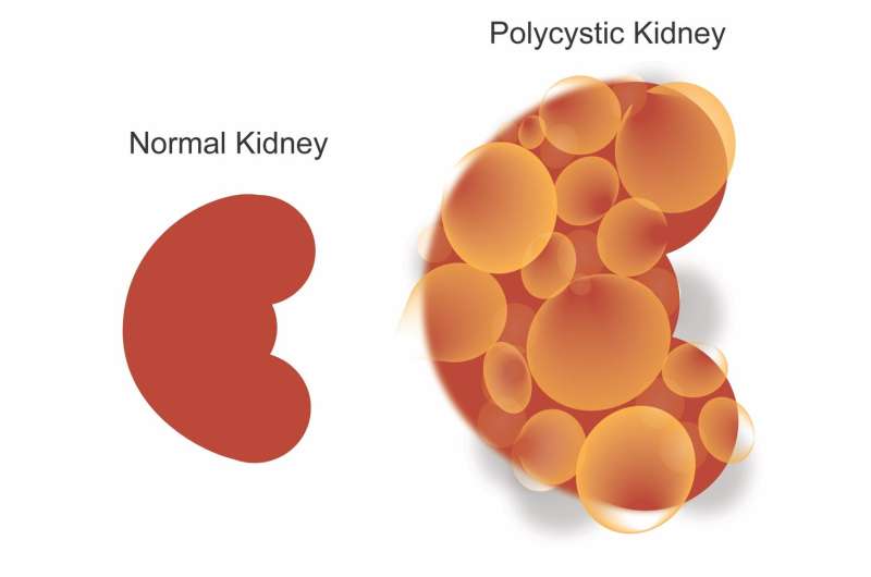 A promising treatment for an incurable, deadly kidney disease
