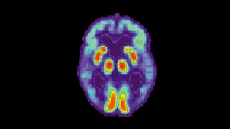 Artificial intelligence can detect Alzheimer’s disease in brain scans six years before a diagnosis