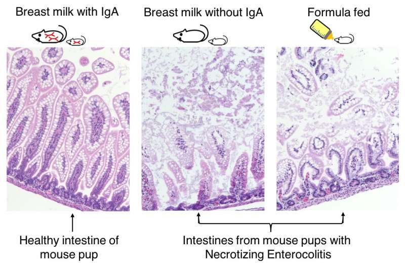 Breastmilk antibody protects preterm infants from deadly intestinal disease