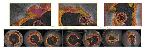 First-in-human imaging study shows improved heart attack prediction