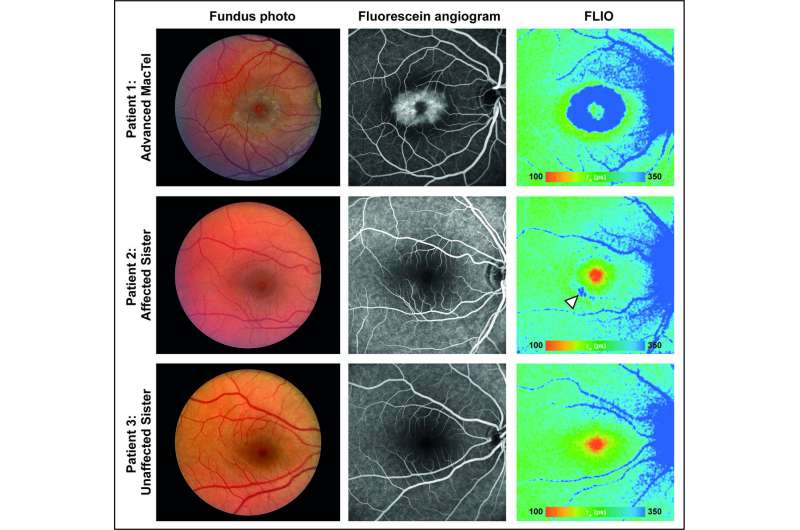 Genetic discovery linked to rare eye disease, MacTel