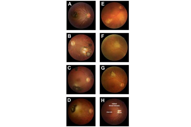 How nasty Toxoplasma parasite damages the human eye