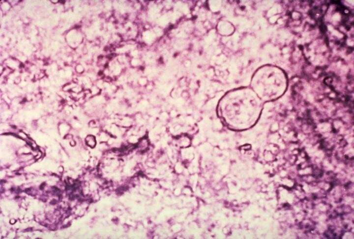 Investigation into fungal infection reveals genetic vulnerability in Hmong