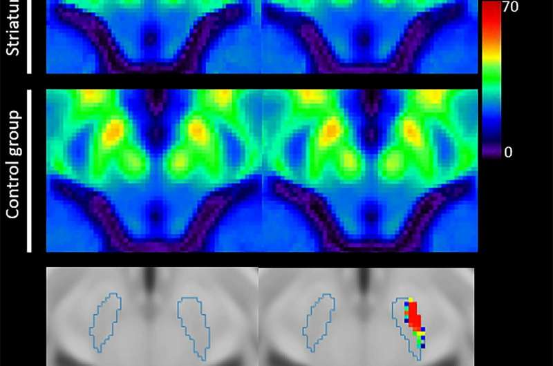 Iron measurements with MRI reveal stroke's impact on brain
