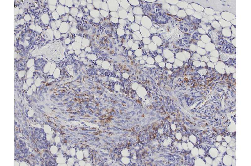 New method identifies aggressive breast cancer