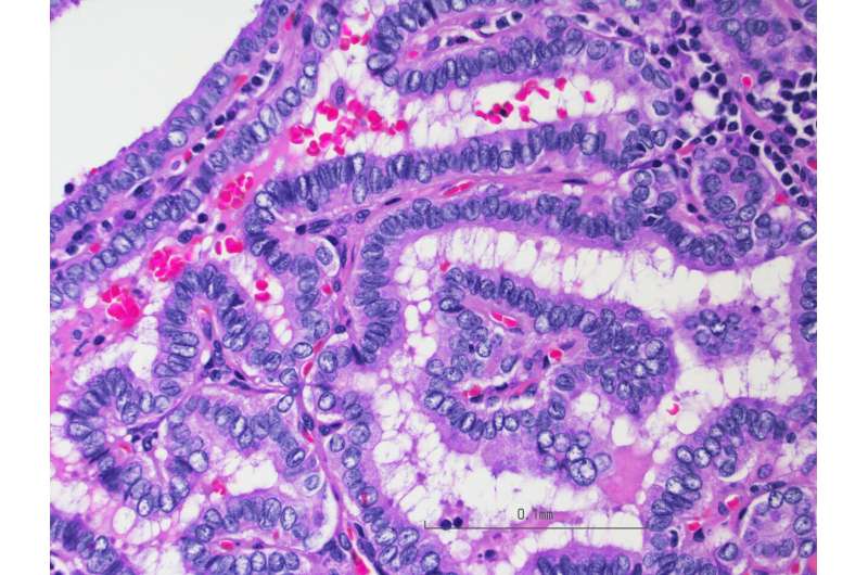 New test for thyroid cancer could prevent unnecessary surgery