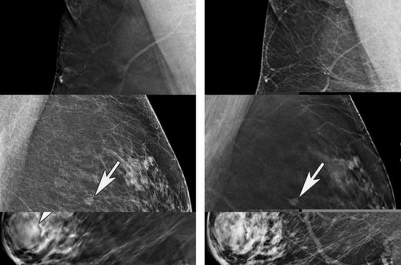 Older women benefit significantly when screened with 3D mammography