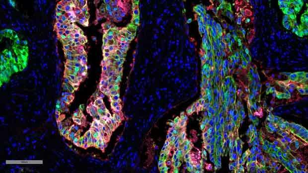 Revealing a potential new marker for aggressive prostate cancer