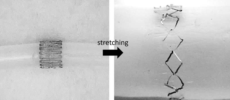Stretchable wireless sensor could monitor healing of cerebral aneurysms