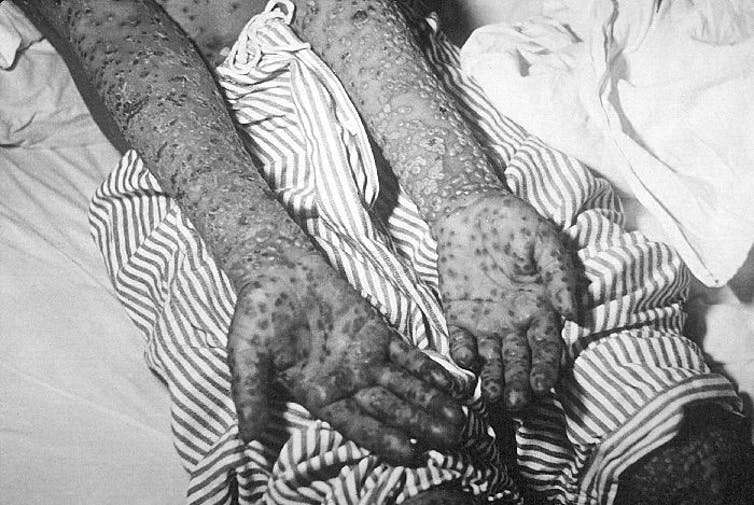 These memoirs show us the role women had in eradicating smallpox from India