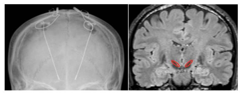 Voluntary control of brainwaves in deep brain of patients with Parkinson's disease