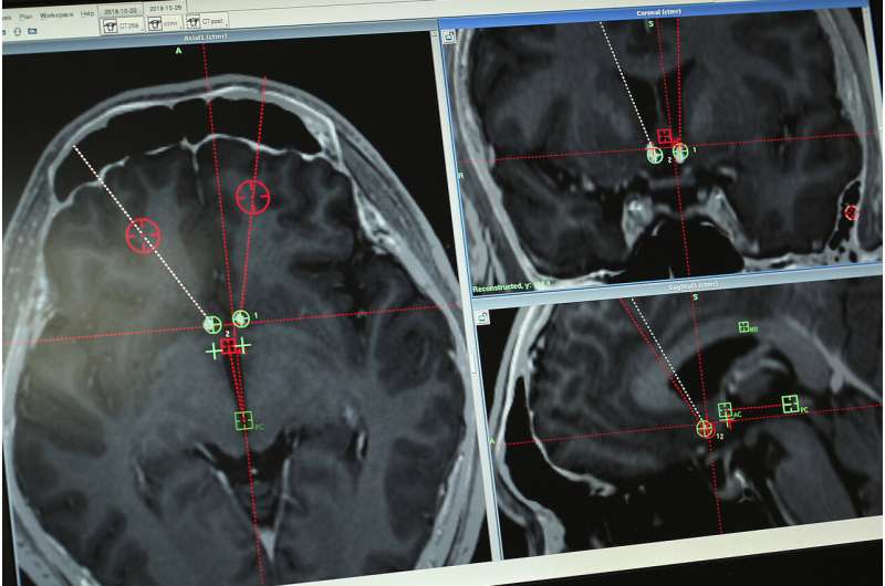 Experimental brain implants studied as opioid deaths rise