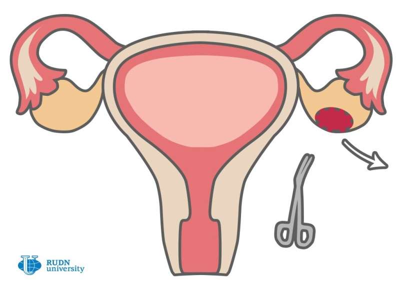 RUDN大学的内科医生发现了一种在子宫内膜异位症治疗期间降低不孕风险的方法