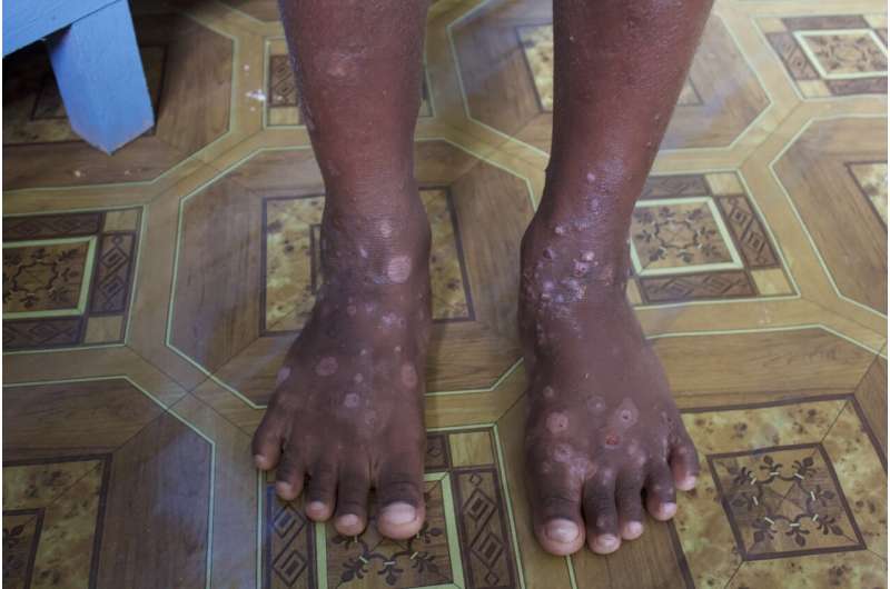International experts call for action for world's 450 million scabies sufferers