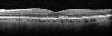 Researchers discover new biomarker for age-related macular degeneration