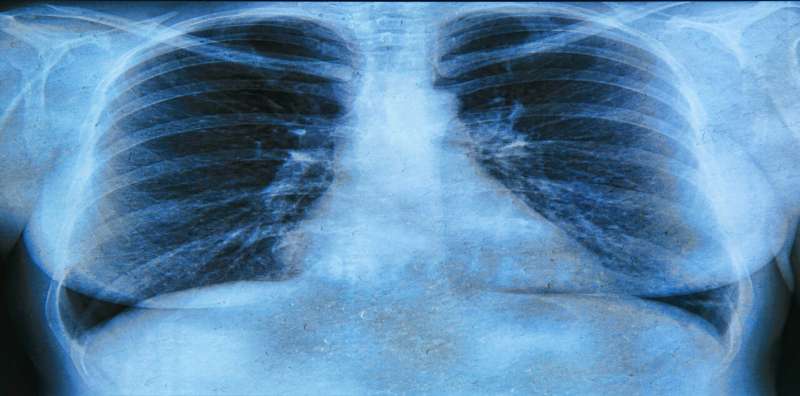 Researchers find window of opportunity for treatment of early cystic fibrosis lung infections