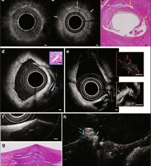 Cardiac imaging with 3-D cellular resolution using few-mode interferometry to diagnose coronary artery disease