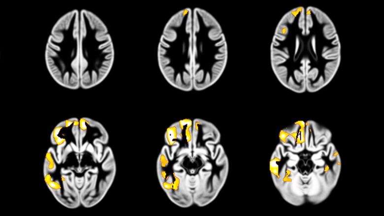 Developmental changes in the brain may influence how often adolescents get drunk