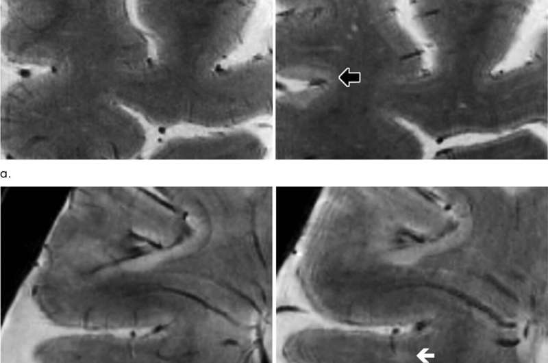 High-strength MRI tracks MS progression