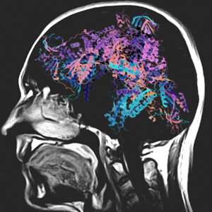一个国际科学家小组发现了罕见的儿童大脑紊乱的原因