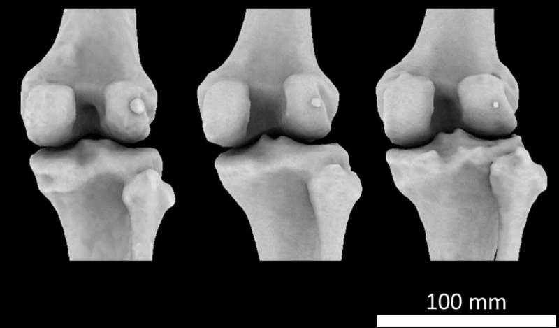 Mystery arthritis-linked knee bone three times more common than 100 years ago