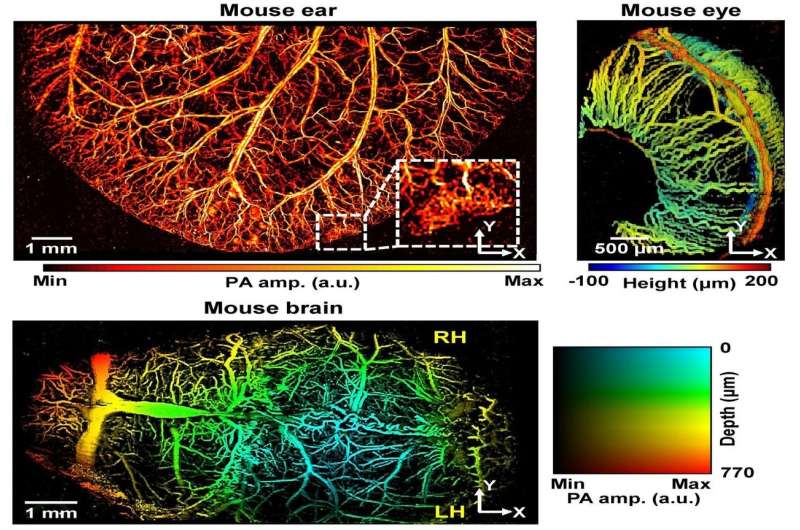 Super-resolution photoacoustic microscopy finds clogged blood vessels
