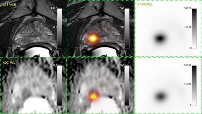 Study explores new tracer in prostate cancer hunt