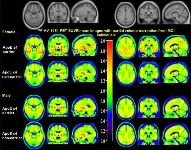 Alzheimer's disease: Sex affects tau accumulation in the brain