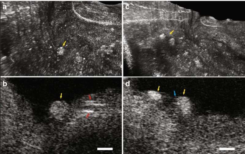 Cardiac imaging with 3-D cellular resolution using few-mode interferometry to diagnose coronary artery disease
