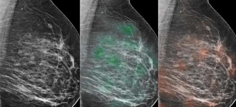 Combination of AI and radiologists more accurately identified breast cancer