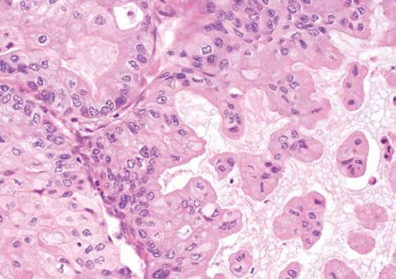 More accurate diagnosis for rare ovarian cancer type