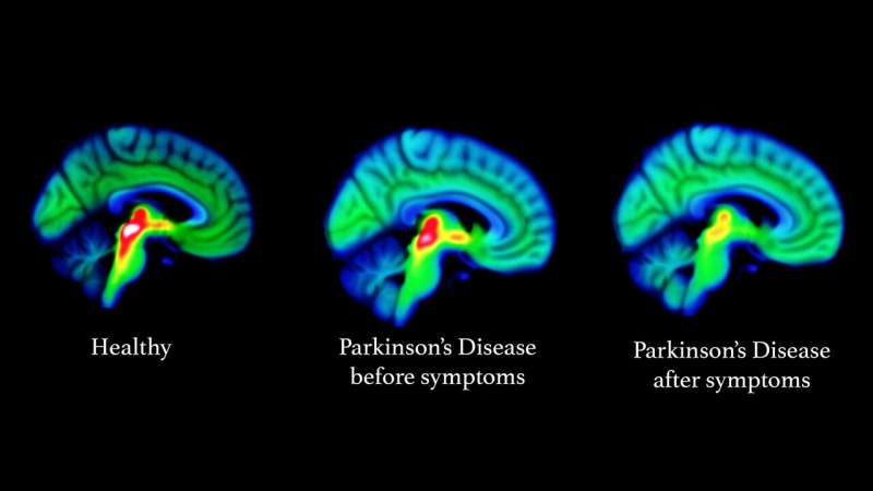 Study reveals roots of Parkinson's in the brain