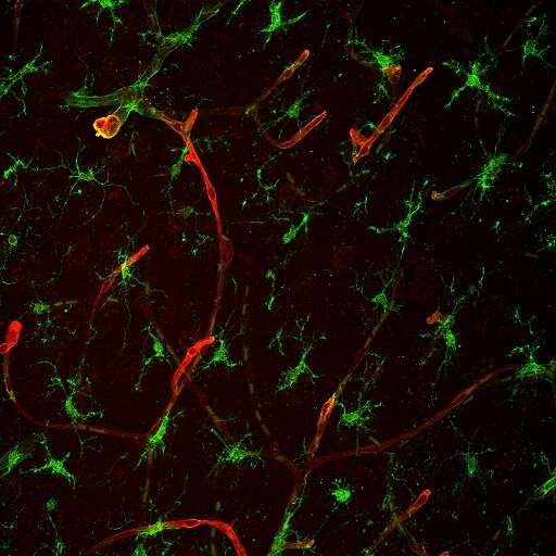 Scientists identify protein that promotes brain metastasis