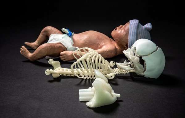 3-D printed baby dummy for better resuscitation training
