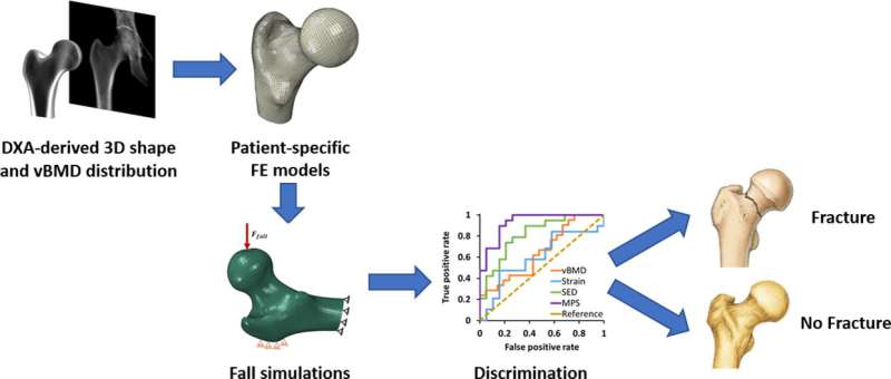 3D simulation of bone densitometry predict better the risk of fracture due to osteoporosis
