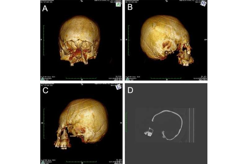 Earliest evidence of artificial cranial deformation in Croatia during 5th-6th century
