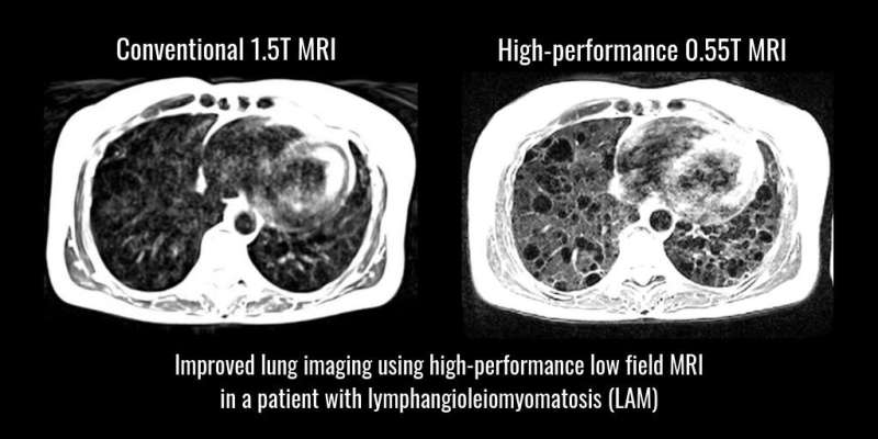 NIH researchers develop MRI with lower magnetic field for cardiac and lung imaging condition