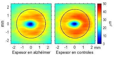 研究人员已经确定了轻度阿尔茨海默症患者视网膜上发生变化的区域