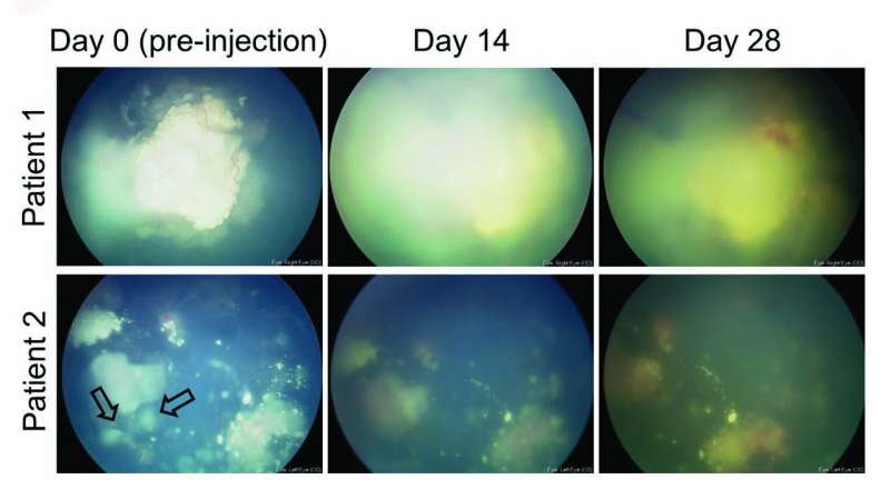 **Genetically modified virus shown able to kill tumors in mice with retinoblastoma