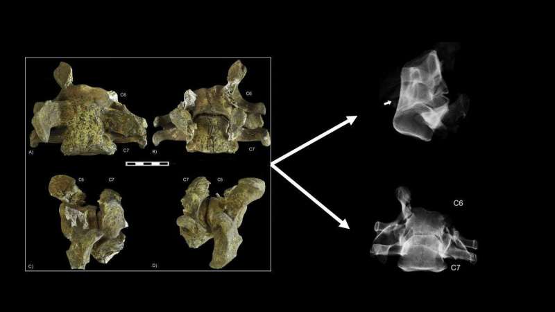 First evidence for an unusual congenital pathology in cave bears