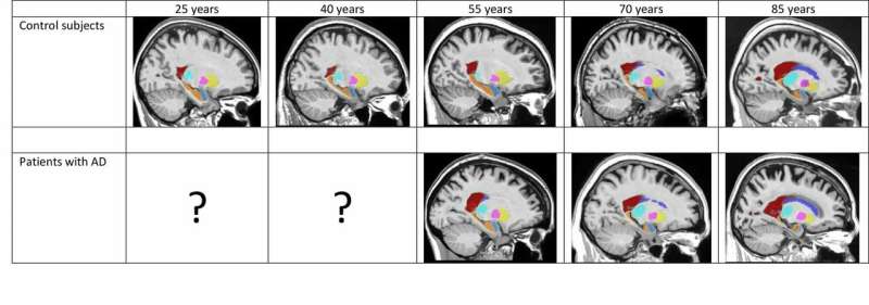 How does the brain change over the course of Alzheimer's?