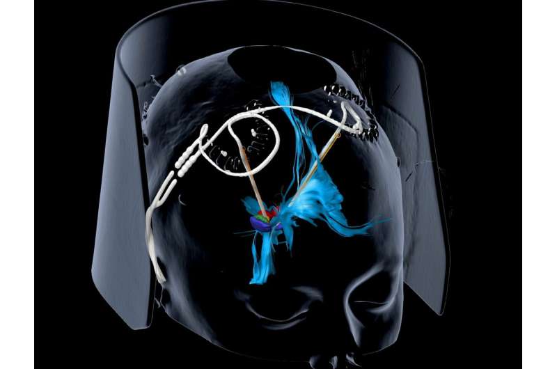 Deep brain stimulation provides sustained relief for severe depression