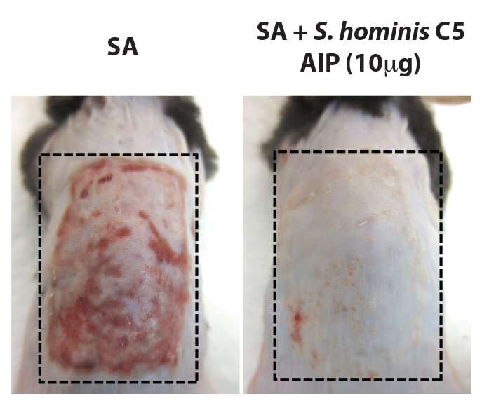Study shows skin microbiome imbalance likely behind eczema flareups