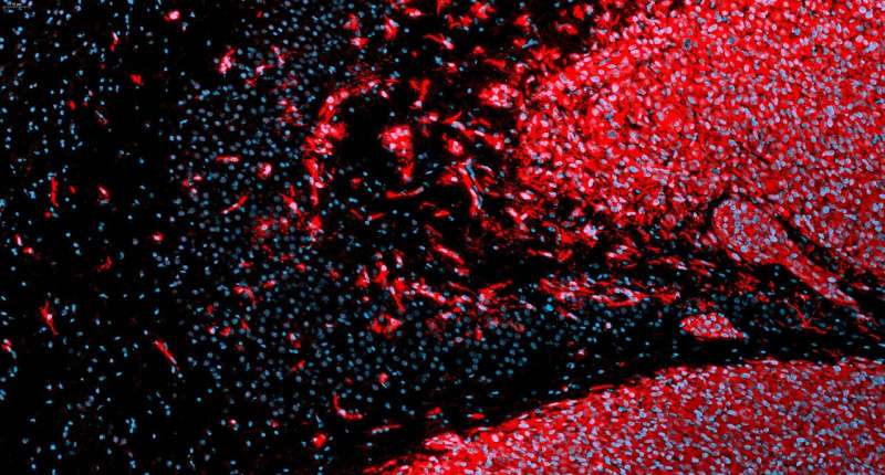 Researchers discover the Achilles' heel of an aggressive brain cancer  - Could antihistamine be a potential aid in defeating can